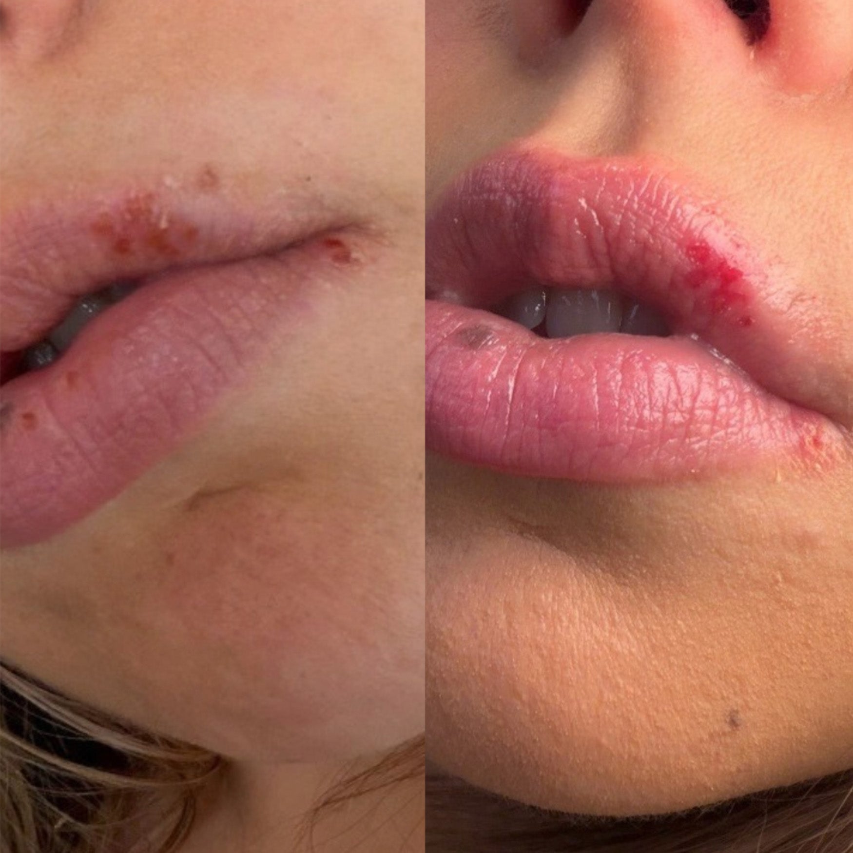 Lysine Lip Healing Patches