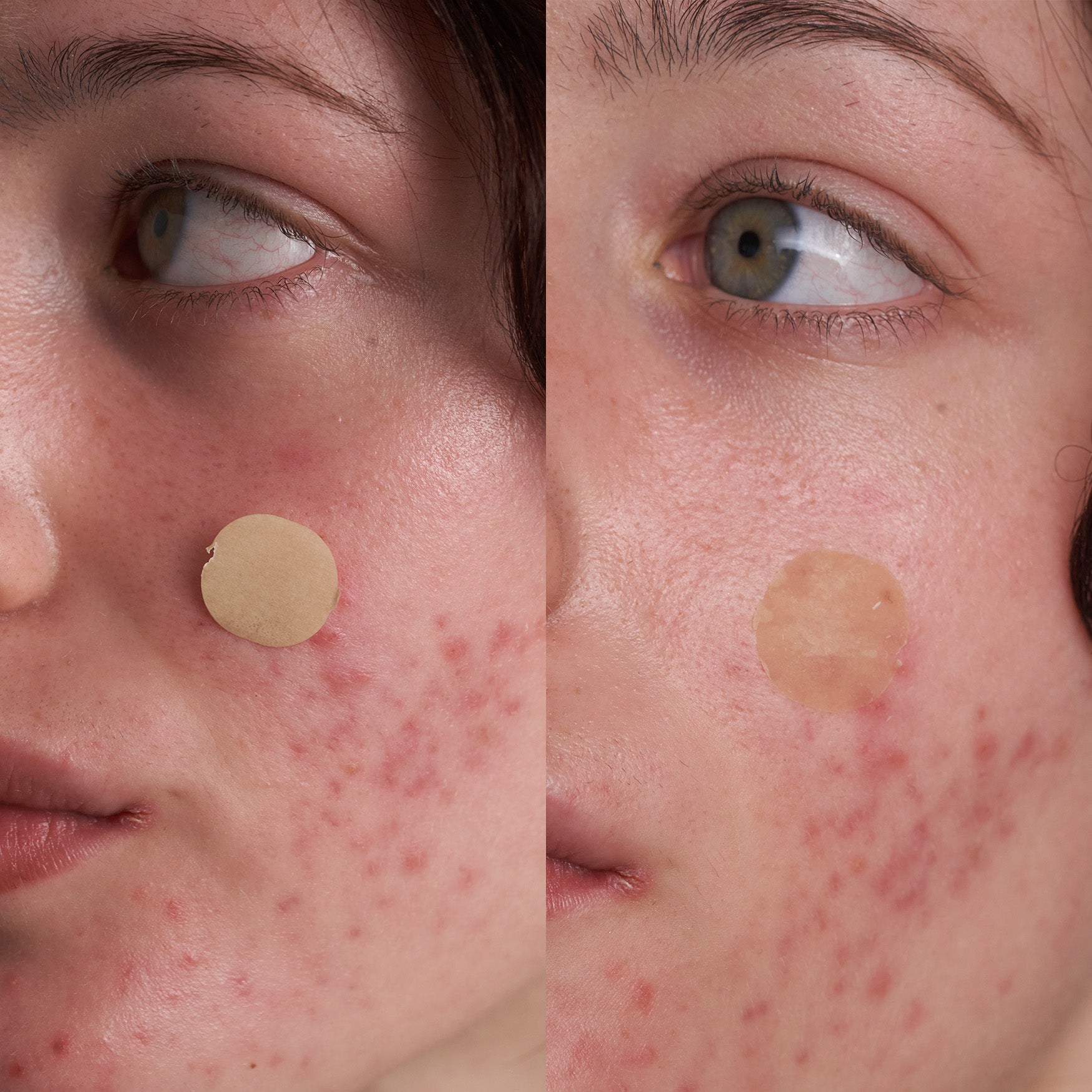 Blemish-Fighting Spot Dots