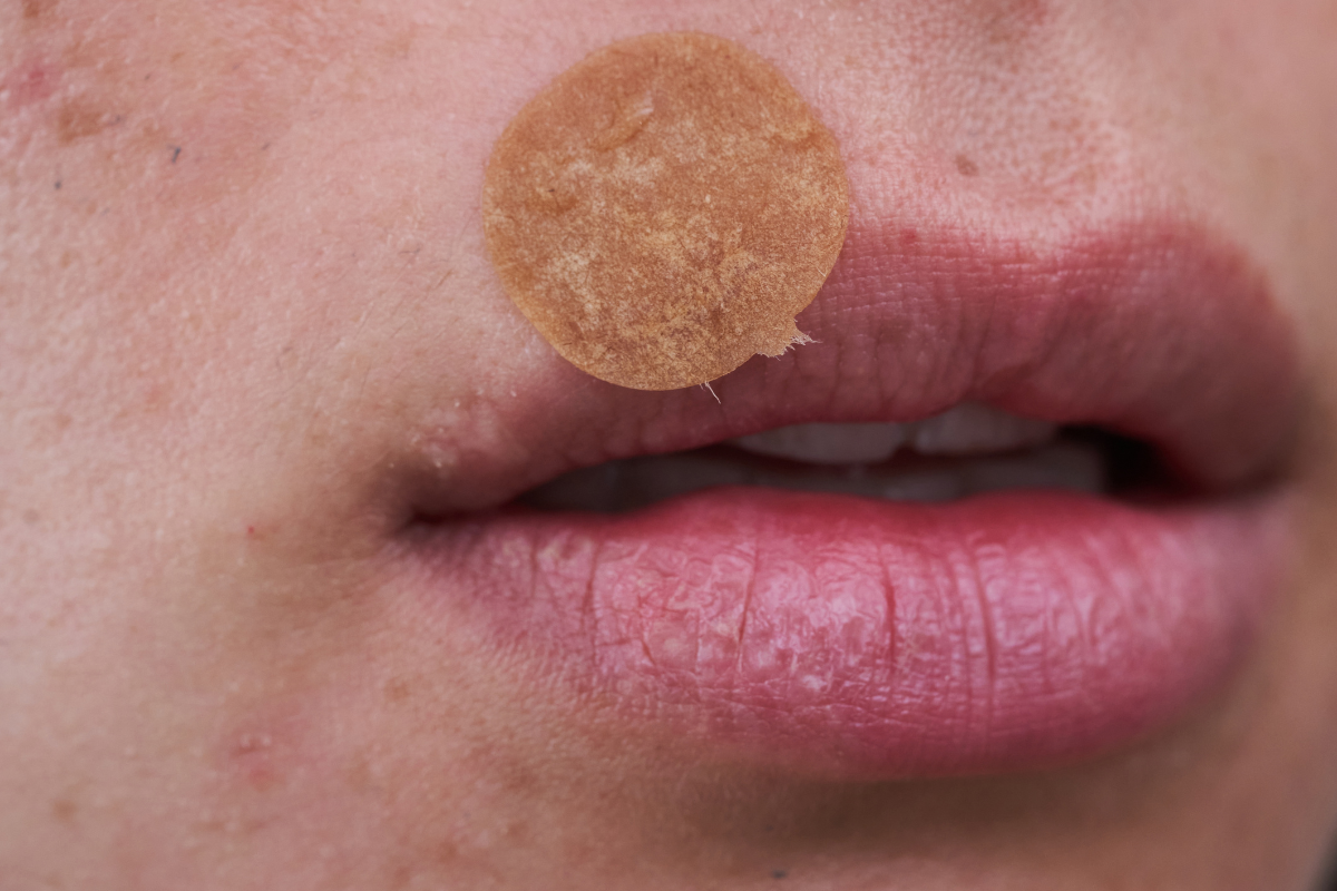 Cold Sore Patches vs Creams vs Lip Care: What's the Difference?