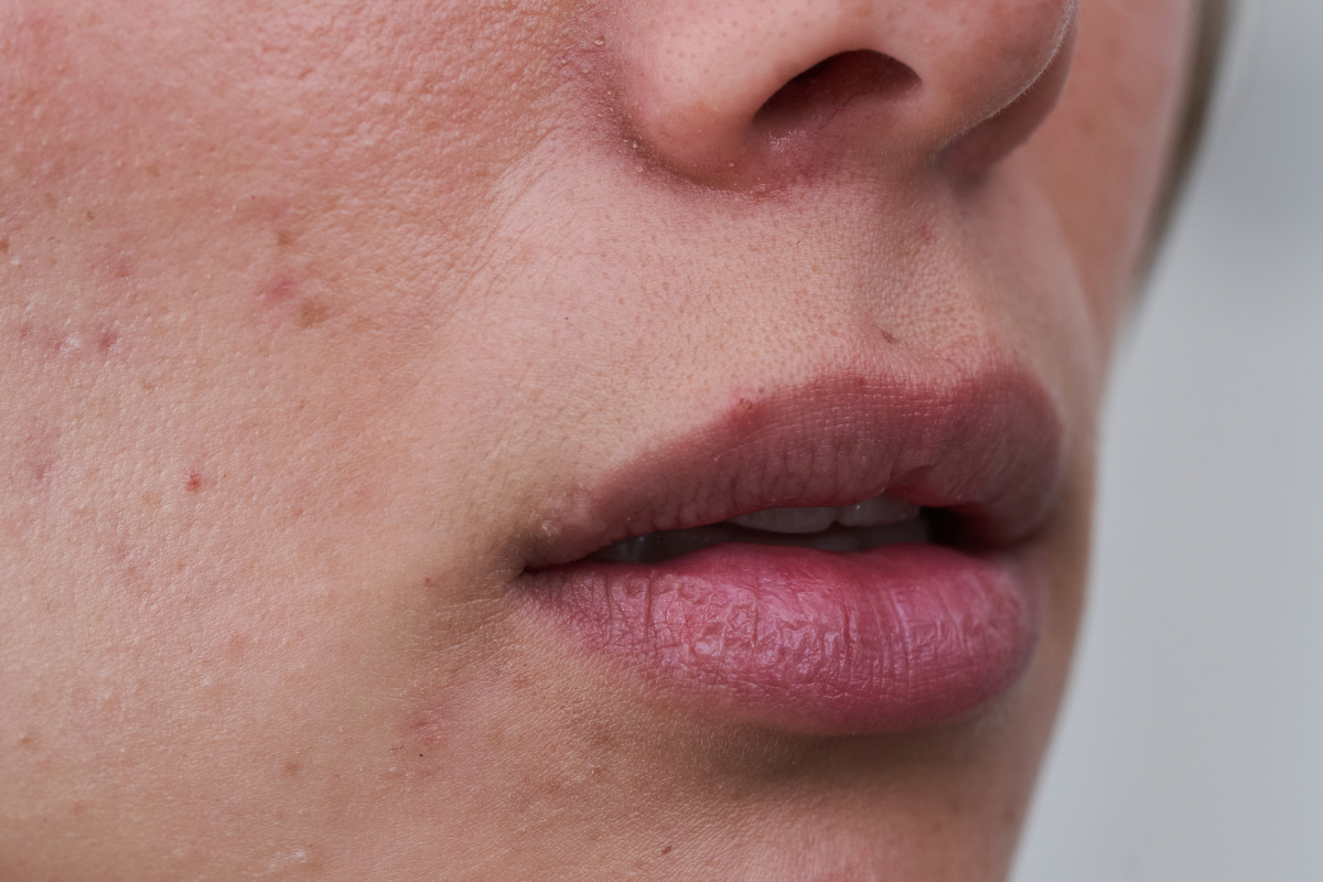 Cold Sore or Pimple? How to Tell the Difference