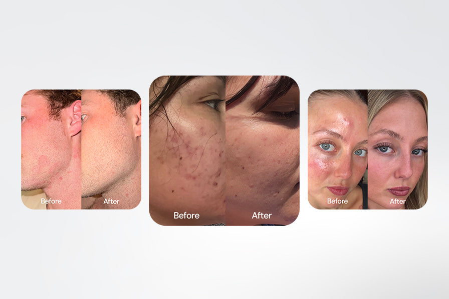 The Makeup Removal Step That's Causing Your Breakouts (And How to Fix It)