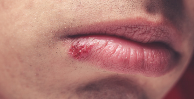 Cold Sore Survival Guide: Stages, Triggers & What Helps