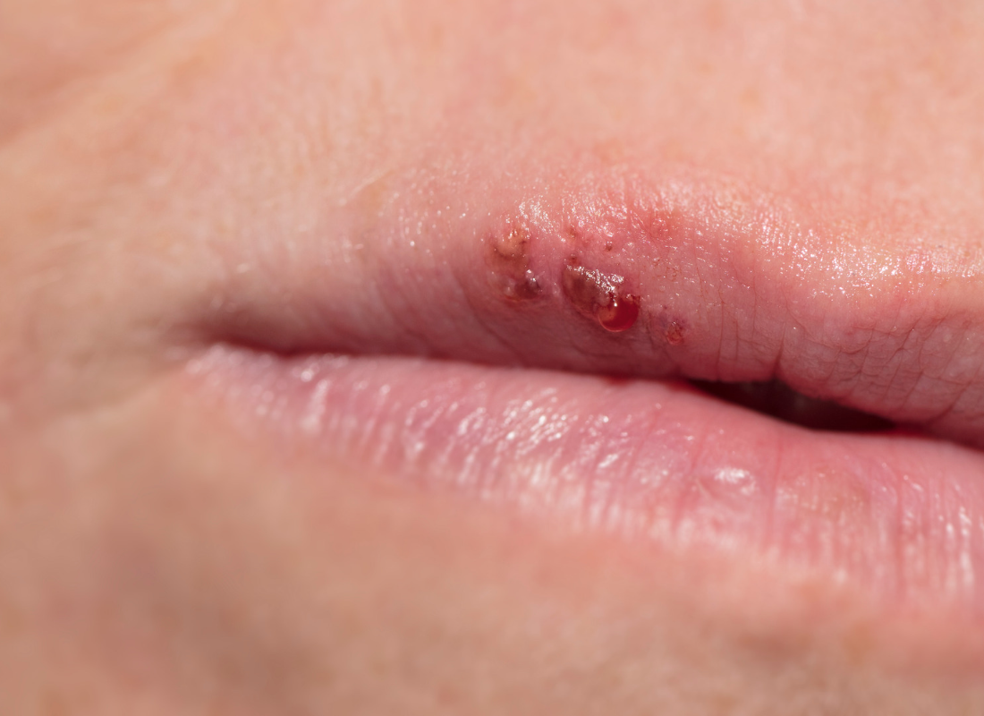 Cold Sore Before a Date, Wedding or Big Event? Here's What to Do