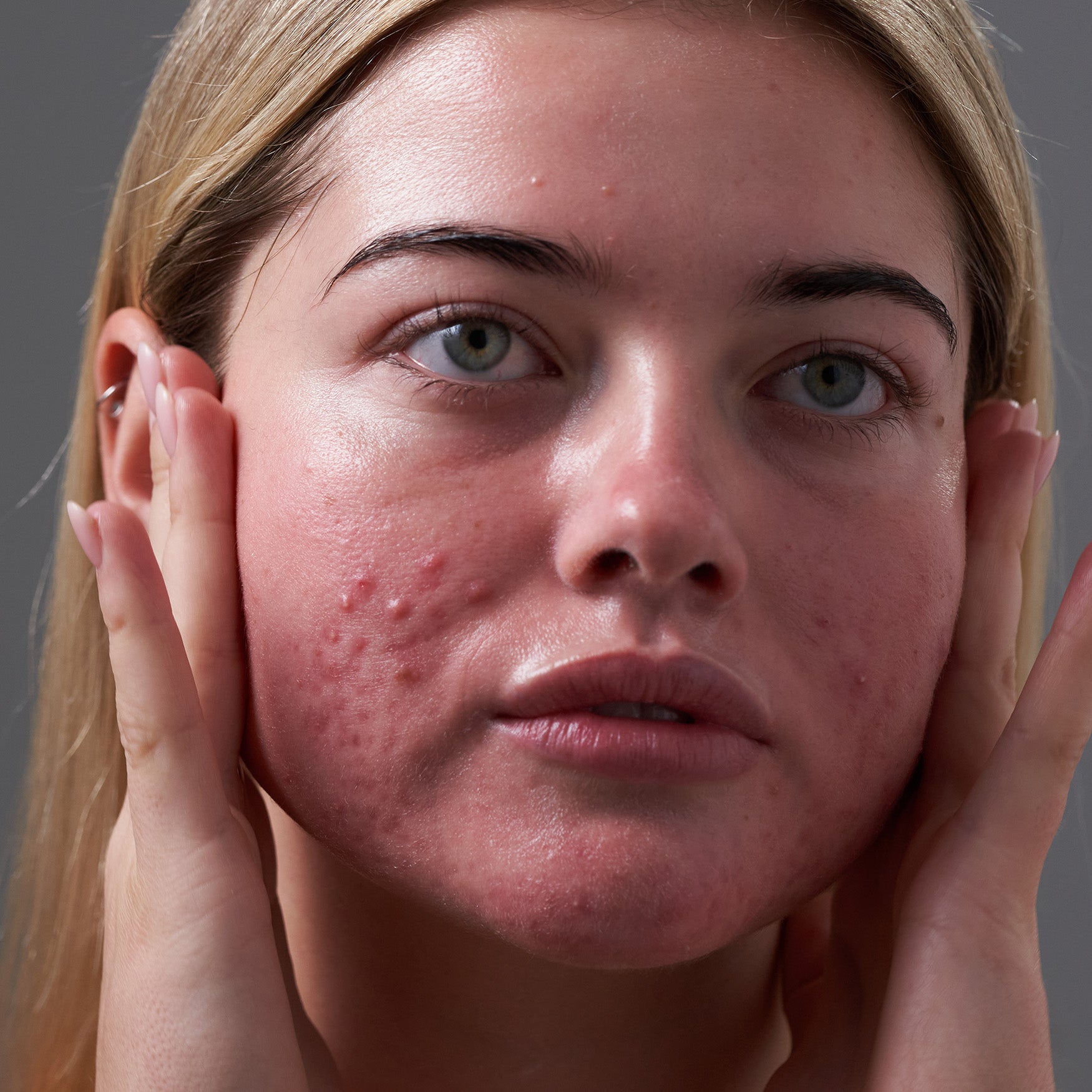 Anti-Acne Duo