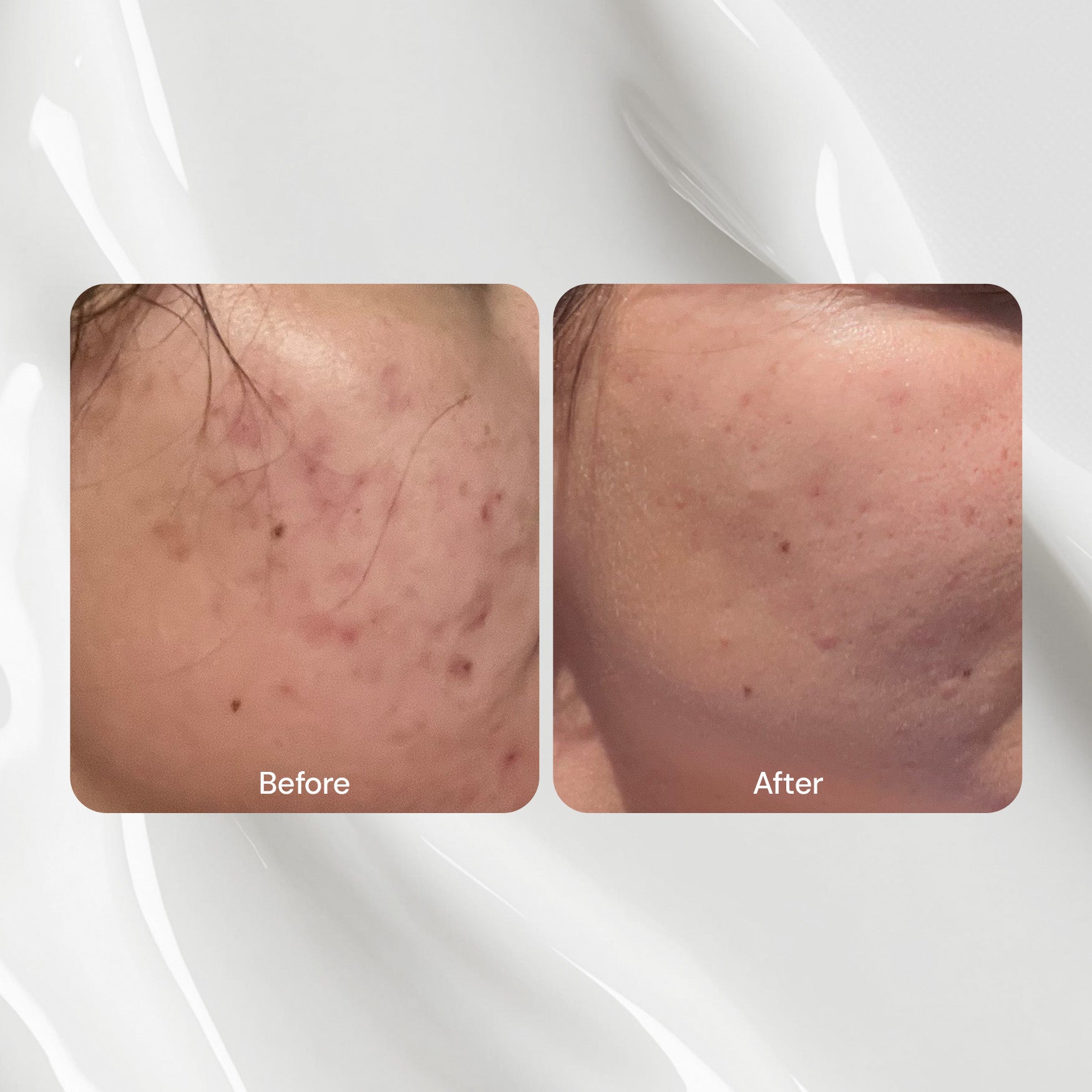 Skin Clearing Gel Moisturizer